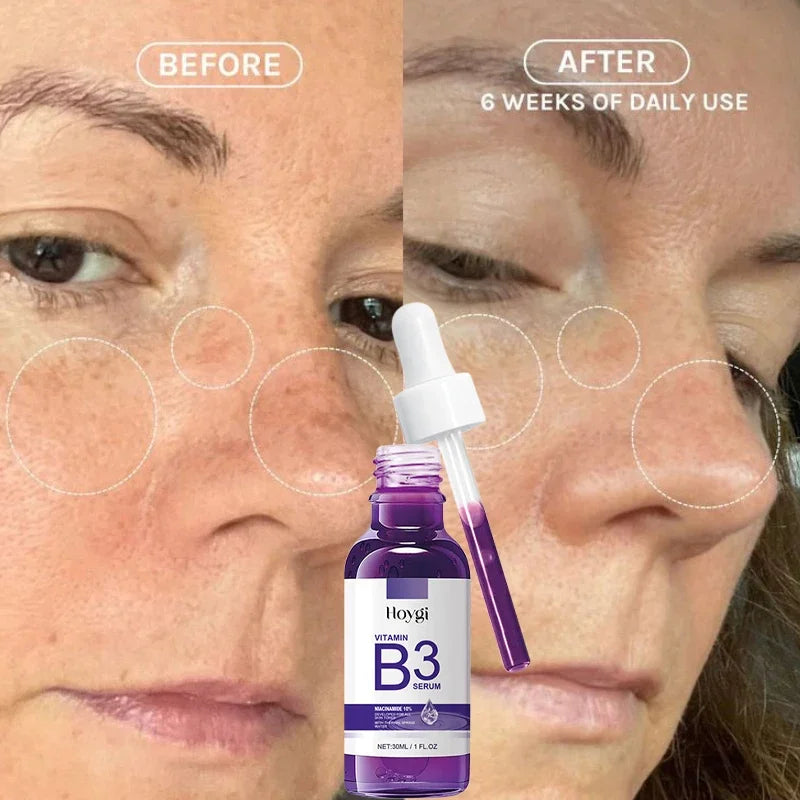Hoygi Niacinamide Facial Serum Vitamin B3 Wrinkles Pigment Dark Spot Removal Correcting Glow Serum Face Whitening Moisturizer