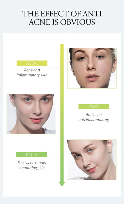 LAIKOU Aloe Vera Gel Soothing Skin Care Remove Acne Moisturizing After Sun Lotions Whitening Moisturizing Acne Treatment Cream