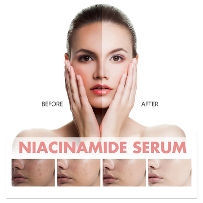 Niacinamide Facial Serum Improves Skin tone,Fades Dark Spots and Acne Improves Enlarged Pores Natural Anti-Aging Face Essence
