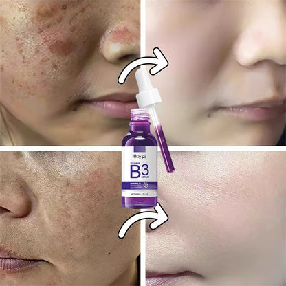 Hoygi Niacinamide Facial Serum Vitamin B3 Wrinkles Pigment Dark Spot Removal Correcting Glow Serum Face Whitening Moisturizer