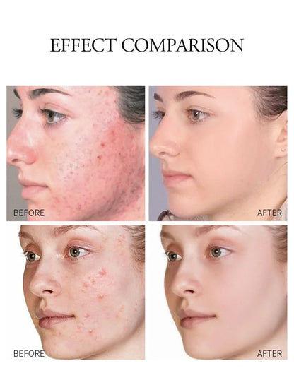 LAIKOU Aloe Vera Gel Soothing Skin Care Remove Acne Moisturizing After Sun Lotions Whitening Moisturizing Acne Treatment Cream