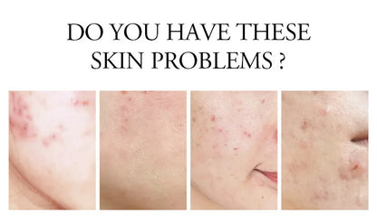 LAIKOU Aloe Vera Gel Soothing Skin Care Remove Acne Moisturizing After Sun Lotions Whitening Moisturizing Acne Treatment Cream