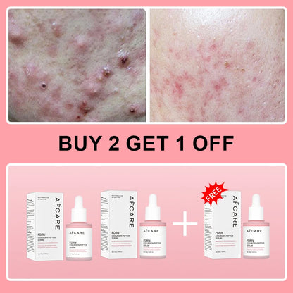 Complex Peptide Acne Serum PDRN Collagen Shrink Pores Fade Melanin Smooth Brightening Skin Korean Skincare Products