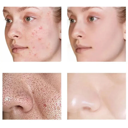 Salicylic Acid Pores Shrink Cream Refining Large Pore Improve Face Acnes Blackhead Remove Cream Anti-aging Oil Control Skin Care